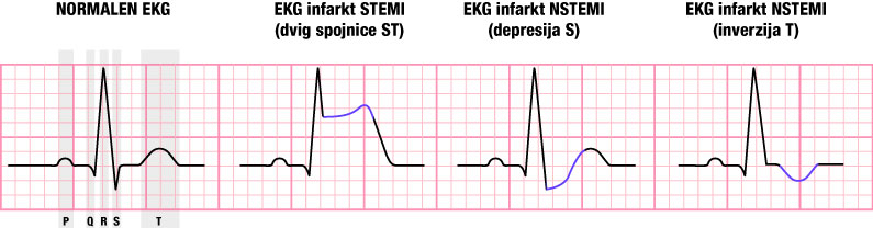 EKG pri različnih oblikah infarkta